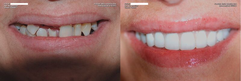 a patient's full arch dental implants restoration, before and after their treatment
