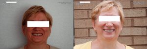 a patient's smile before and after her full mouth restoration