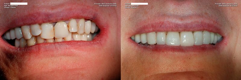 a patient's teeth before and after having a full mouth restoration