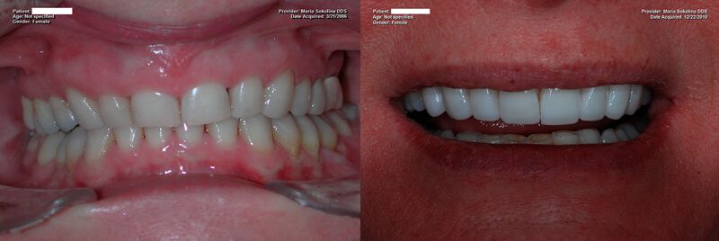 a patient's teeth before and after their porcelain veneer procedure