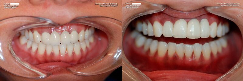 a patient's teeth before and after dental crowns and veneers