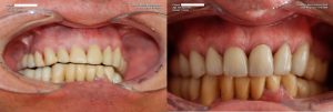 a patient's teeth before and after a dental cleaning