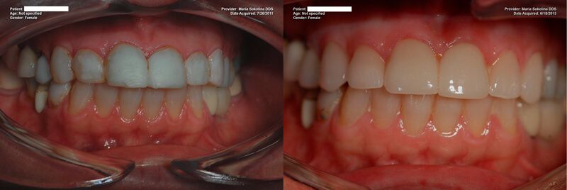 a patient's teeth before and after replacing the composite bonding with dental veneers