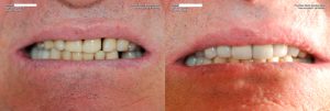 a patient's teeth before and after their full mouth restoration