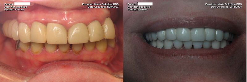 a patient's teeth before and after their full mouth dental implants restoration