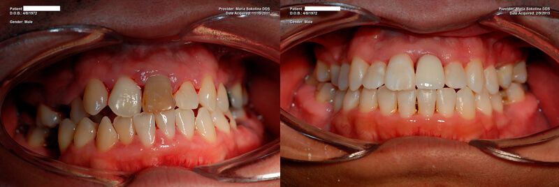 a patient's teeth before and after their full mouth restoration