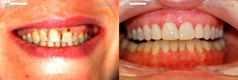 a patient's teeth before and after an oral exam and dental cleaning