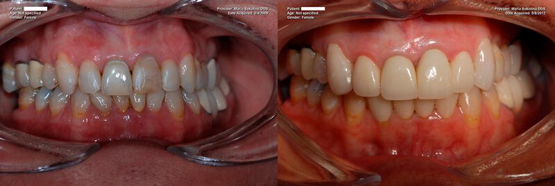 a patient's teeth before and after their tooth-colored fillings