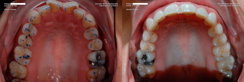 a patient's teeth before and after a full mouth restoration