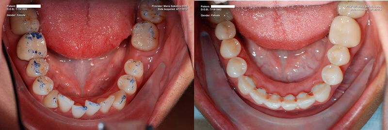 a patient's teeth before and after placing a dental crown and multiple dental bridges