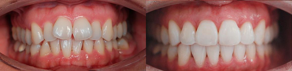 Patient dental before and after photo 1