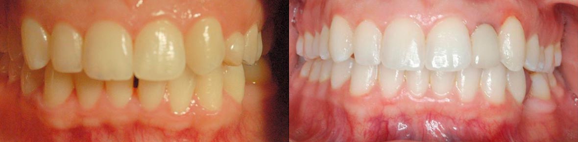 Patient dental before and after photo 2