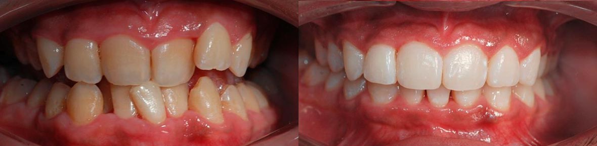Patient dental before and after photo 3