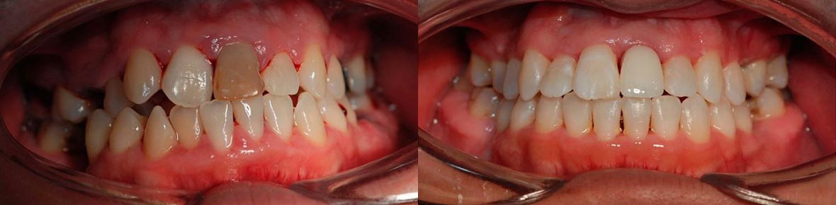 Patient dental before and after photo 4