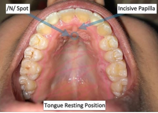 Tongue Resting position