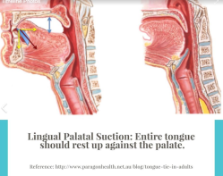 Lingual Palatal Suction
